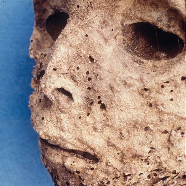история, Древняя мумия содержит самое раннее свидетельство существования гепатита В